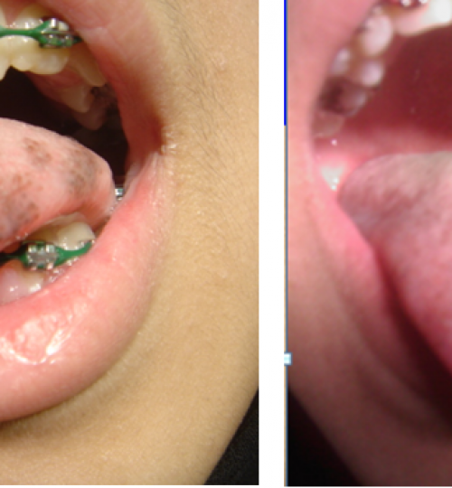 depigmentation tongue laser